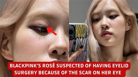 blackpink rose double eyelid.